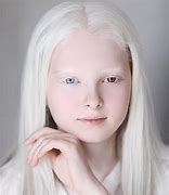 Image result for albino child eyes