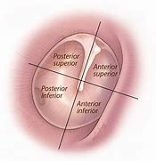 Image result for Tympanic Perforation