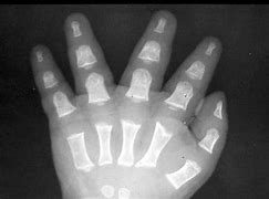 Image result for Trident Hand Achondroplasia