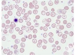 Image result for Target Cells RBC