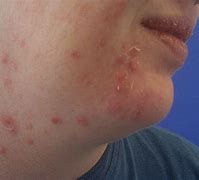 Image result for What Are Papules On the Skin