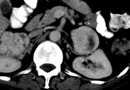 Image result for Pheochromocytoma CT Abdomen