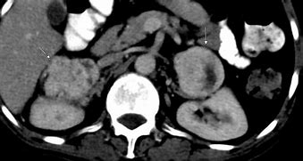 Image result for Large Pheochromocytoma CT