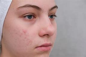 Image result for Pimple Face Lady