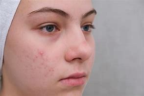 Image result for Pimple Face HD Images