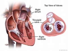 Image result for Tricuspid Myxoma