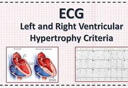 Image result for Right Ventricular Hypertrophy Echo