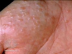 Image result for Best Treatment for Dyshidrotic Eczema