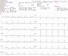 Image result for Dilated Cardiomyopathy EKG