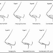 Image result for Columella Septum