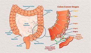 Image result for Human Body Colon Cancer