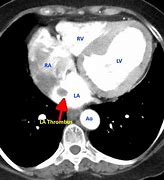 Image result for Cardiac CT Left Atrial Appendage Thrombus