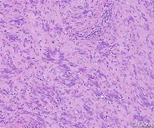 Image result for Vestibular Schwannoma Gross Pathology