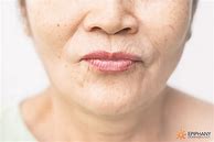 Image result for How to Remove Wrinkles around Mouth