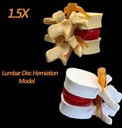 Image result for Lumbar Spine Herniation