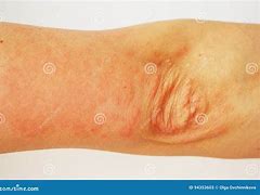 Image result for Allergic Reaction with Pustules