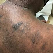 Image result for Eczema On Black Skin with Grey Colour