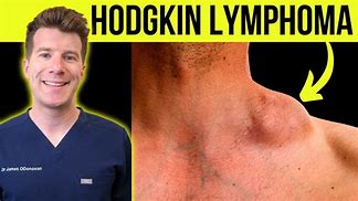 Image result for Hodgkin Lymphoma Cancer Symptoms