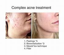 Image result for Demodex On Face