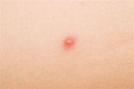 Image result for Papule Pimple