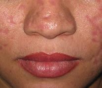 Image result for Atrophic Skin Aging