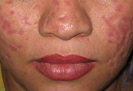 Image result for De Qinjection Atrophy Skin