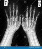 Image result for Normal Hand Radiograph