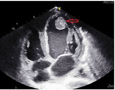 Image result for Right Atrial Thrombus Echocardiogram