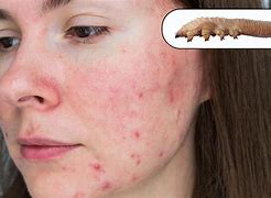 Image result for Killing Demodex Mites On Face