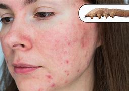 Image result for Demodex Mite Face Rash