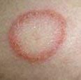 Image result for Circular Rash On Skin