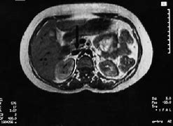 Image result for IVC Thrombs Post-Mortem