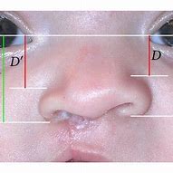 Image result for Nasal Alar Groove