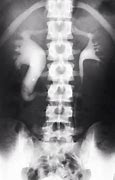 Image result for Retrocaval Surter Radiology