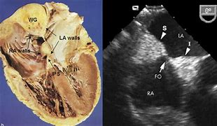 Image result for Interatrial Septum Lipomatous Hypertrophy Echo