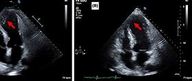 Image result for Sessile Thrombus