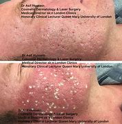 Image result for Subclinical Acne