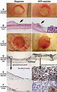 Image result for E Inflamed Tissue