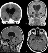 Image result for Coronal Lung CT