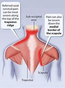 Image result for Nerve Neck Shoulder Pain