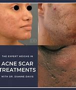 Image result for What Helps with Acne Scars