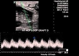 Image result for AV Graft