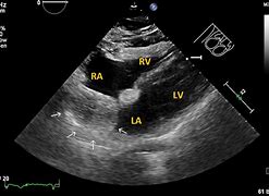 Image result for Interatrial Septum Lipomatous Hypertrophy Echo