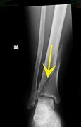 Image result for X-ray of Leg with Metal Plates