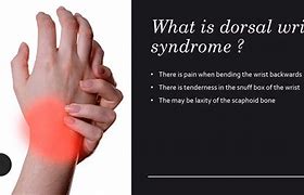 Image result for Dorsal Aspect Wrist