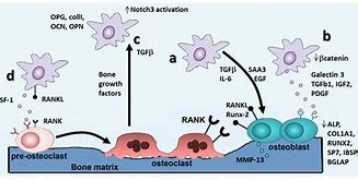 Image result for DDR and Bone Metastasis