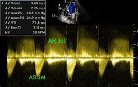 Image result for Aortic Stenosis Doppler