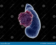 Image result for Kidney Cancer Tumor