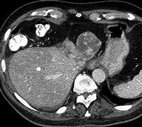 Image result for Hemangioma On Liver