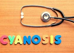 Image result for Cyanosis